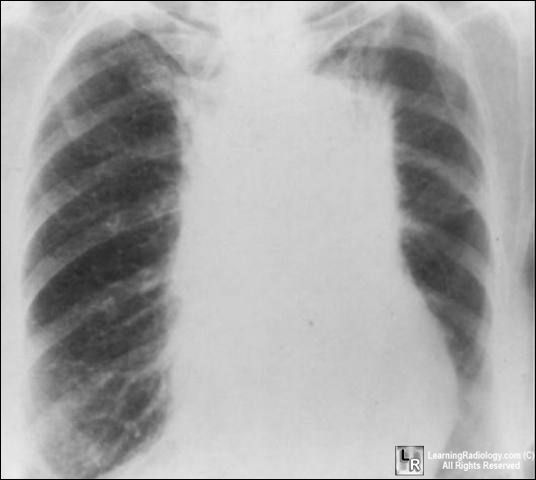 Radiation fibrosis